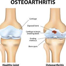 C:\Users\Toshiba\Pictures\web\osteoarthritis-prp-1024x918.png
